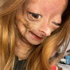 Murió Adalia Rose, la famosa youtuber que padecía del síndrome de Benjamin Button