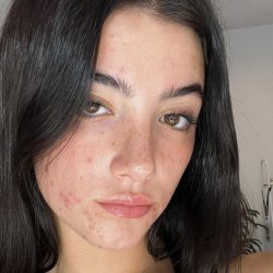 Charli D'Amelio y la naturalización del acné en TikTok