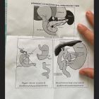 Operacion tumor pancreas Fedez