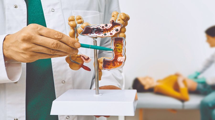 Cáncer de colon: Claves de prevención
