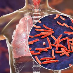 El regreso de una patología clásica: la tuberculosis | Foto:Shutterstock