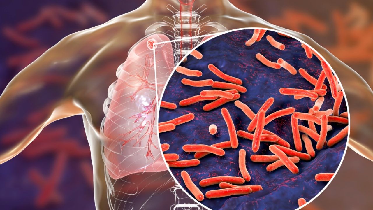 El regreso de una patología clásica: la tuberculosis | Foto:Shutterstock