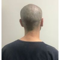 Vidalina MicroScalp