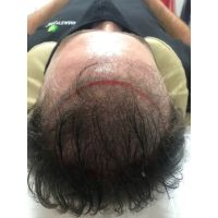 Vidalina MicroScalp