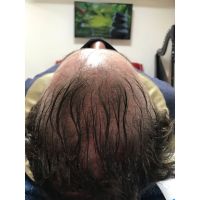 Vidalina MicroScalp