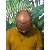 Vidalina MicroScalp