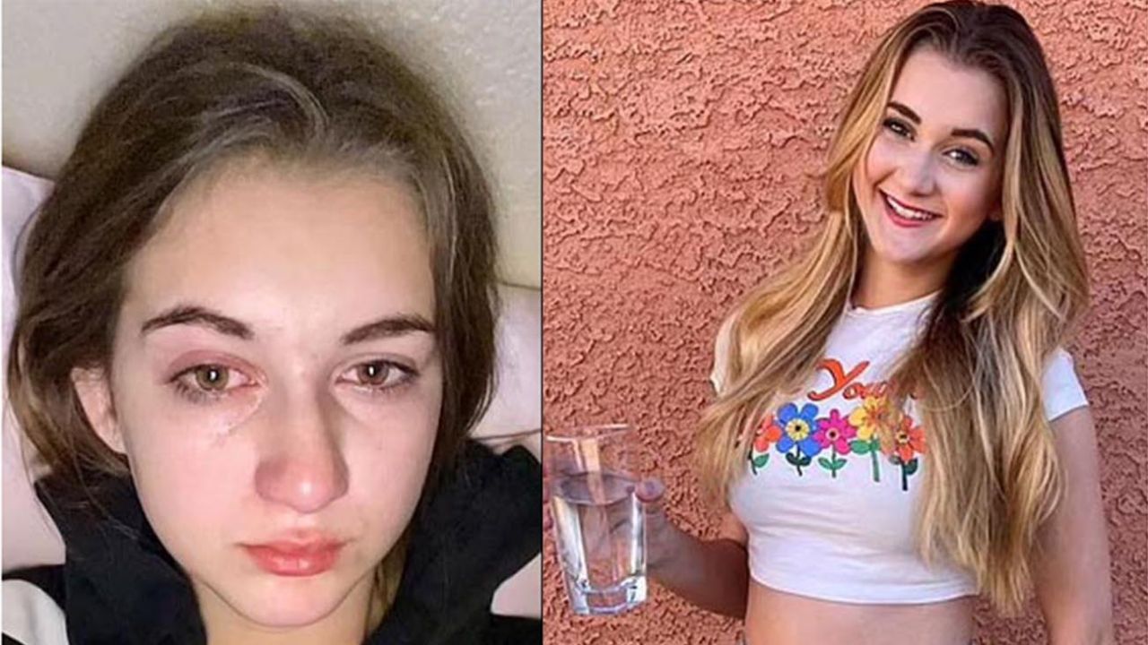 El extraño caso de la joven alérgica al agua: sus propias lágrimas le dañan  la piel | Perfil