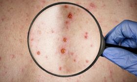 Monkypox: cómo se contagia la viruela de mono