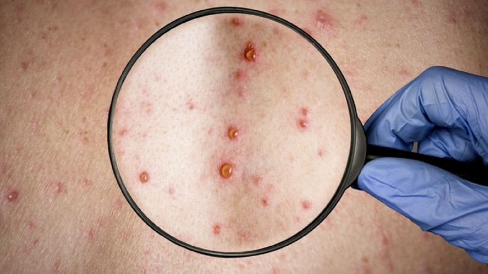 Monkypox: cómo se contagia la viruela de mono