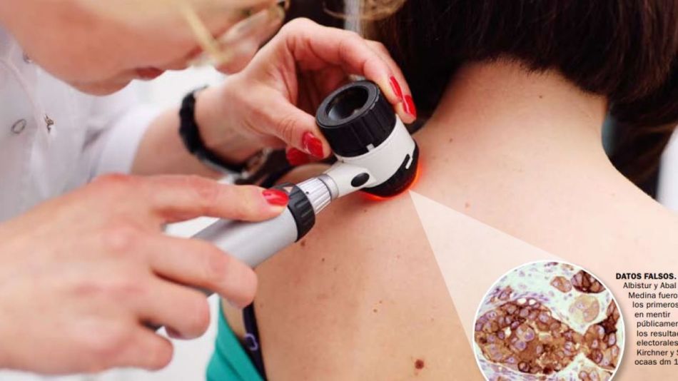 vacuna argentina contra el cáncer de piel