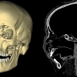 En las imágenes publicadas por los investigadores polacos se puede observar el cráneo de la momia con lesiones, que según creen, fueron causadas por un tumor,