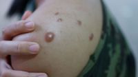 viruela monkeypox