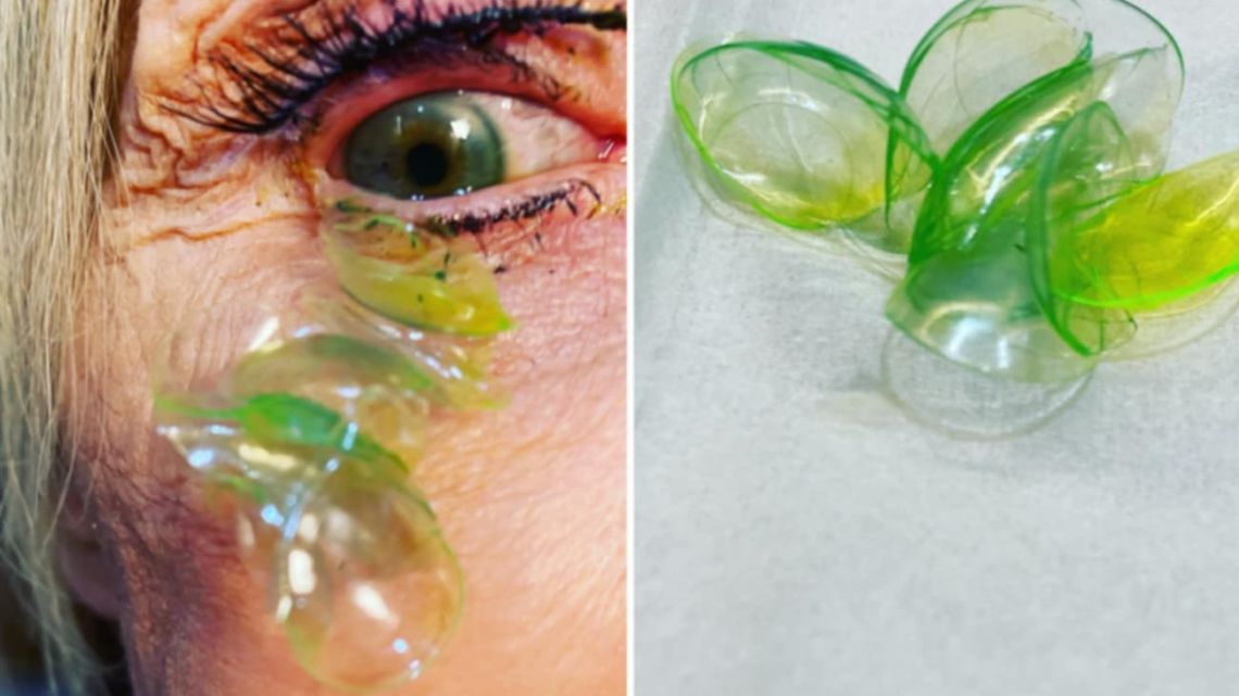 Einer 70-jährigen Frau wurden 23 Kontaktlinsen aus den Augen entfernt
