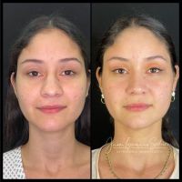 Rinoplastia Moderna