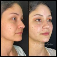 Rinoplastia Moderna