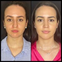 Rinoplastia Moderna