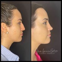 Rinoplastia Moderna