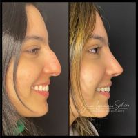 Rinoplastia Moderna