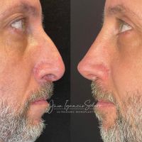 Rinoplastia Moderna