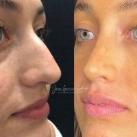 Rinoplastia Moderna