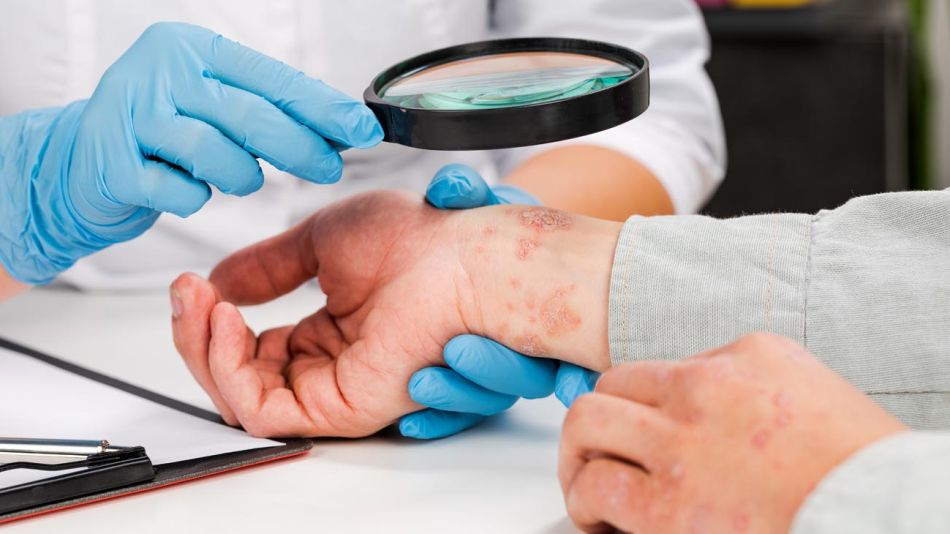 Melanoma