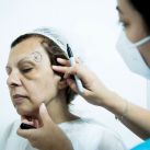 Lipofiling facial: la cirugía que te rejuvenece con tu propia grasa
