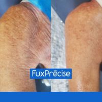 FUXPRÉCISE, El tratamiento ideal y a medida para tu piel