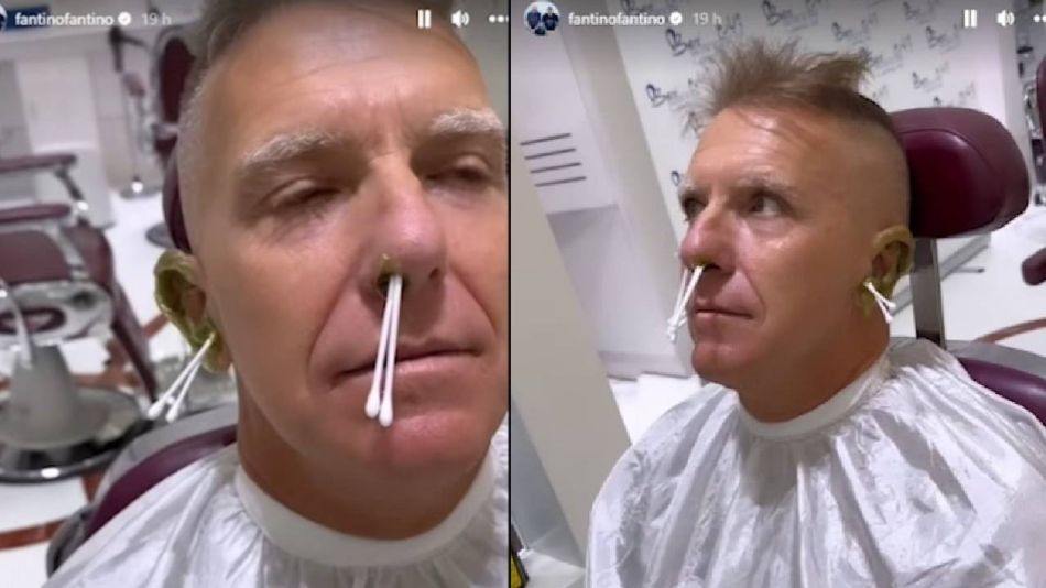 Alejandro Fantino se sometió a un método de depilación facial en Dubai