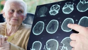 Cuba avanza en un medicamento contra el Alzheimer