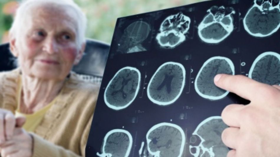 Cuba avanza en un medicamento contra el Alzheimer