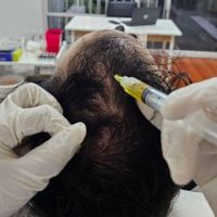 BENEFICIOS DEL PLASMA RICO EN PLAQUETAS