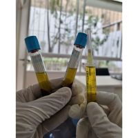 BENEFICIOS DEL PLASMA RICO EN PLAQUETAS