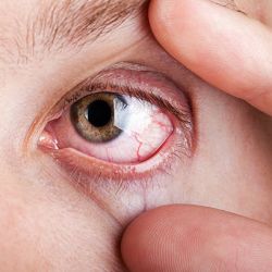 Te contamos las causas del ojo seco y como combatirlo
