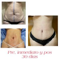 Reconstrucción abdominal de excelencia