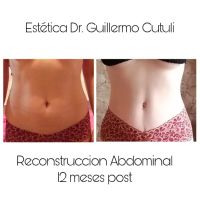 Reconstrucción abdominal de excelencia