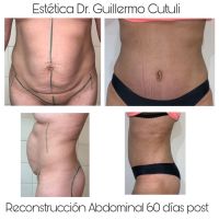 Reconstrucción abdominal de excelencia