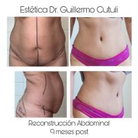Reconstrucción abdominal de excelencia