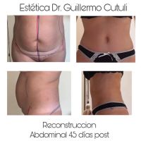 Reconstrucción abdominal de excelencia