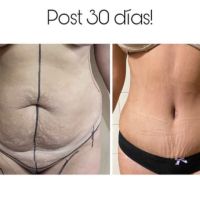 Reconstrucción abdominal de excelencia