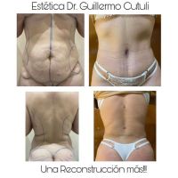 Reconstrucción abdominal de excelencia