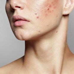 Combatí tus granitos con estos ingredientes de skin care