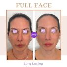 “La nueva tendencia que hace furor en rejuvenecimiento facial: los Skin builders”. Dra. Inés Añó