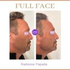 “La nueva tendencia que hace furor en rejuvenecimiento facial: los Skin builders”. Dra. Inés Añó