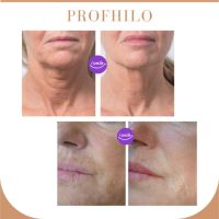 “La nueva tendencia que hace furor en rejuvenecimiento facial: los Skin builders”. Dra. Inés Añó