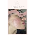 Dra. Josefina Sánchez: ¡Tengo acné como a los 18 años!