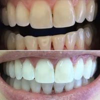 Od. Camila Denughes: “Blanqueamiento dental”