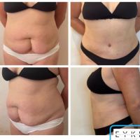 Dermolipectomía Abdominal: ¿qué es?