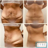 Dermolipectomía Abdominal: ¿qué es?