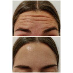 Tratamiento multidisciplinario del bruxismo neuromiorrelajación con TENNS y placa de reposicionamiento mandibular (a cargo del Odontólogo ) + Botox en el músculo masetero (masticador) | Foto:CEDOC