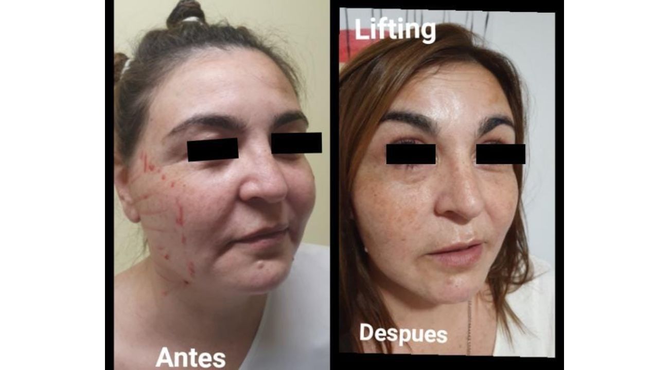 Lifting facial